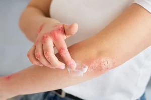 Enfermedades inflamatorias: alimentos que ayudan a mejorar los síntomas