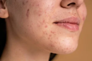 Qué comer y qué evitar si tienes acné hormonal